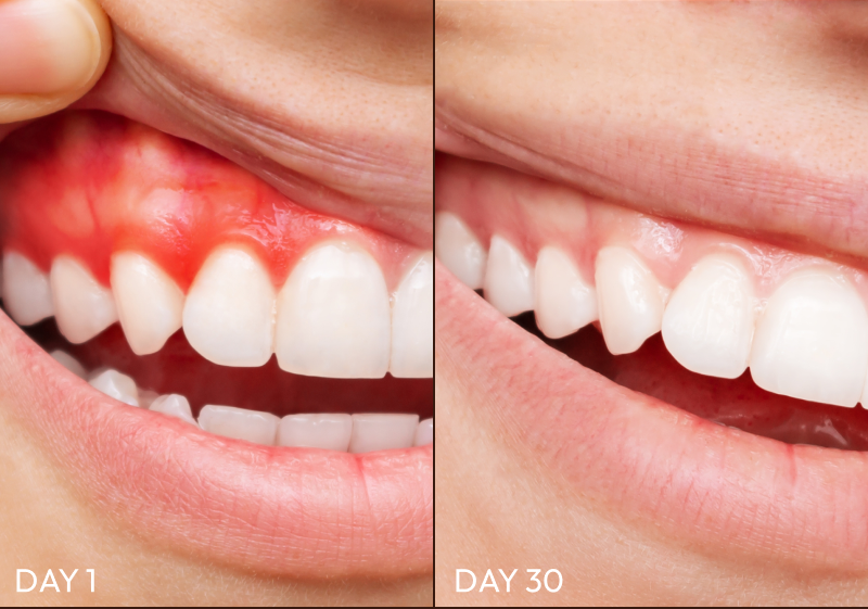 Before and After Images of Gum Restore
