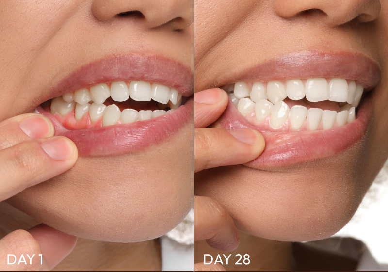 Before and After Images of Gum Restore