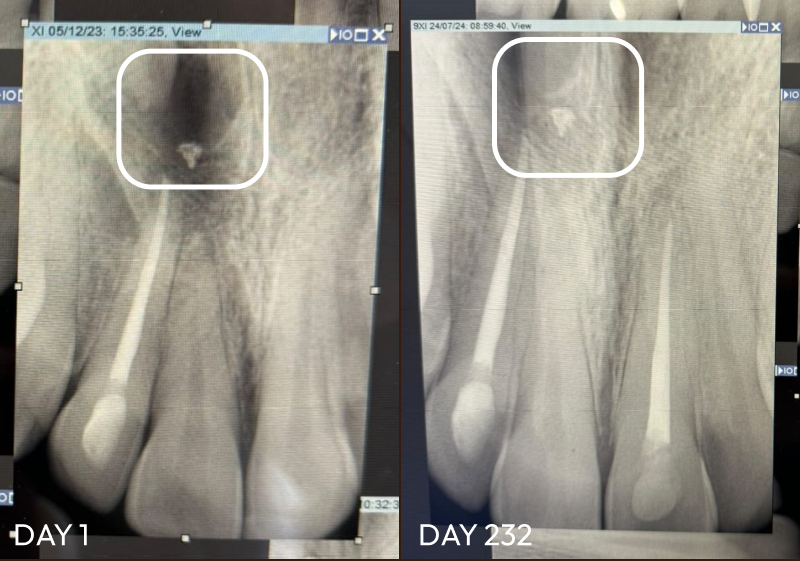 Xray of before and after Tooth Restore
